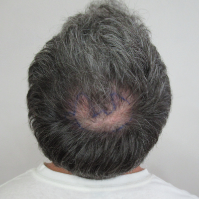 Alopecia Areata