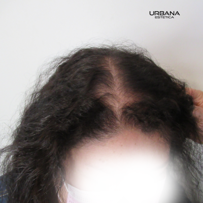 Alopecia Femenina