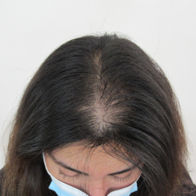 Alopecia Femenina