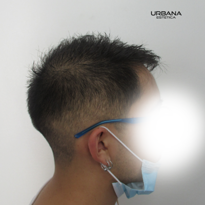 Alopecia Androgenetica