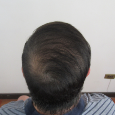 Aumento de densidad Capilar