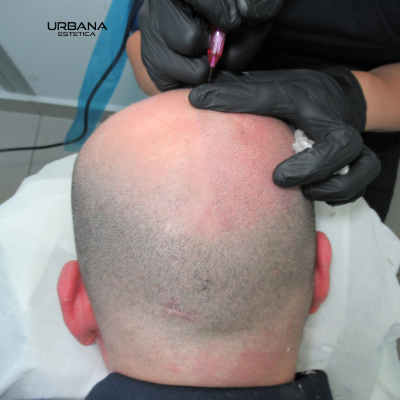 Alopecia extensa