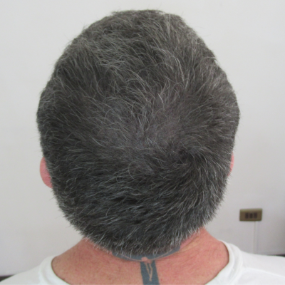 Aumento de densidad Capilar