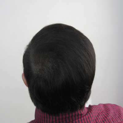 Aumento de densidad Capilar