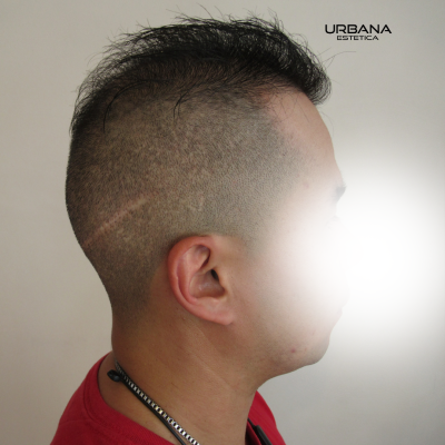 Camufla de Cicatrices